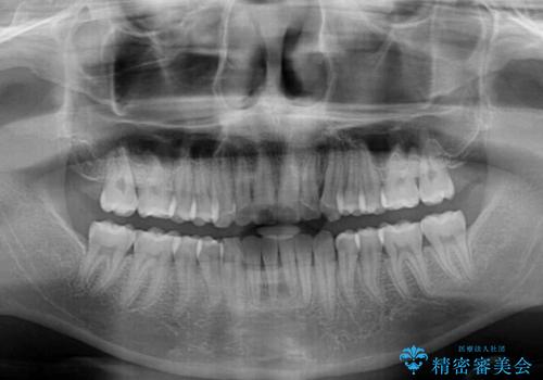 八重歯と奥歯のクロスバイト 上顎骨を拡大してインビザラインで矯正の治療後