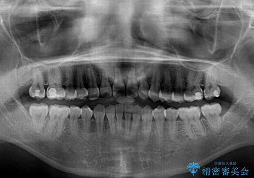 前後に重なった前歯 ワイヤー装置と急速拡大装置を併用したインビザライン矯正の治療後