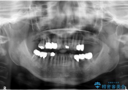 歯ぐきから血が出る、歯ぐきが腫れている 80代女性の治療後