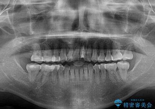 狭い上顎骨を拡大 著しい叢生を抜歯矯正で改善の治療後