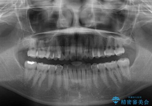 狭い上顎骨を拡大 急速拡大装置を併用したインビザライン矯正の治療後