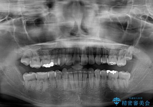 八重歯の抜歯矯正 補助装置を用いたインビザライン矯正の治療後