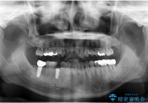 予算を抑えてしっかりとしたインプラント治療 30代男性の治療中