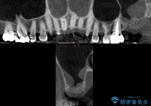 奥歯がわれている　ソケットリフトを併用した奥歯のインプラント　60代男性の治療前