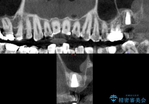 奥歯がわれている ソケットリフトを併用した奥歯のインプラント 60代男性の治療後