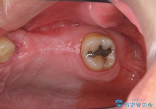 咬合平面を揃え、早期接触・干渉を防ぐ補綴治療の治療前
