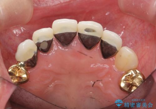 状況に応じた前歯の補綴計画の治療前