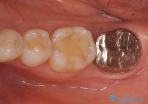 歯が割れた　親知らずの移植　30代女性の症例 治療前