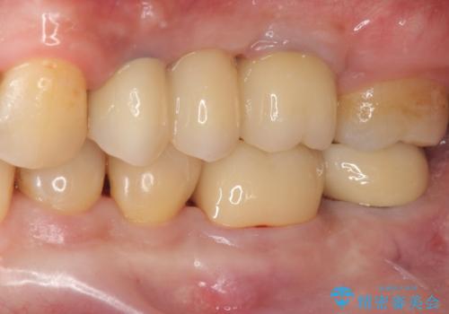 咬合平面を揃え、早期接触・干渉を防ぐ補綴治療の治療後