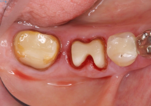 歯ぐきから血が出る、歯ぐきが腫れている 80代女性の治療中