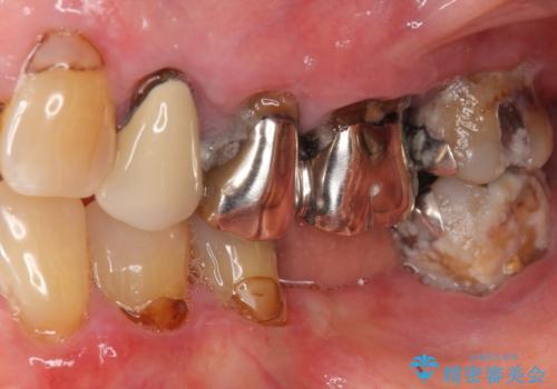 歯ぐきから血が出る、歯ぐきが腫れている 80代女性の治療前