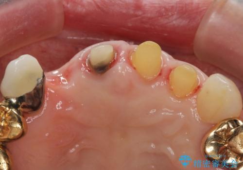 状況に応じた前歯の補綴計画の治療中