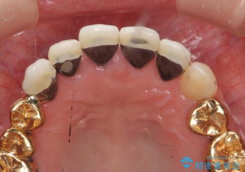 状況に応じた前歯の補綴計画の治療前