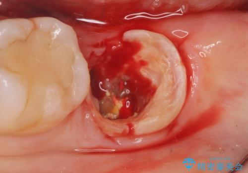歯が割れた 親知らずの移植 30代女性の治療前