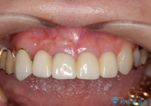 状況に応じた前歯の補綴計画の治療後