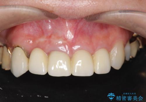 状況に応じた前歯の補綴計画の症例 治療後