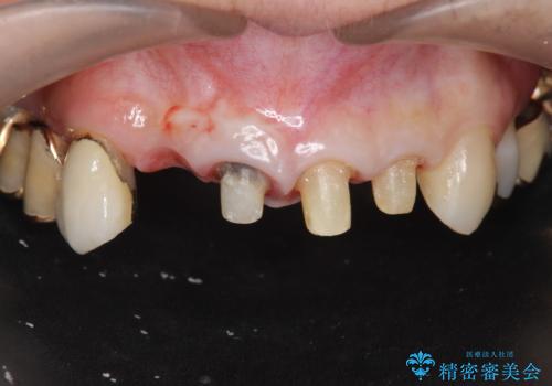 状況に応じた前歯の補綴計画の治療中