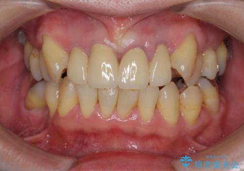 [前歯のグラつき]　根本的な前歯の審美治療を希望の治療後