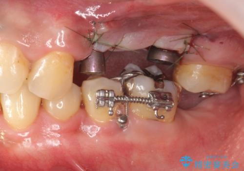 咬合平面を揃え、早期接触・干渉を防ぐ補綴治療の治療中