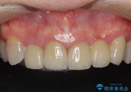[歯ぐきの腫れを改善]  不適合なセラミッククラウンの症例 治療前