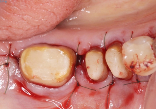 歯ぐきから血が出る、歯ぐきが腫れている 80代女性の治療中