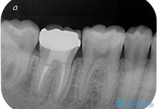 【根管治療】ラバーダムを使用した治療をしてほしい