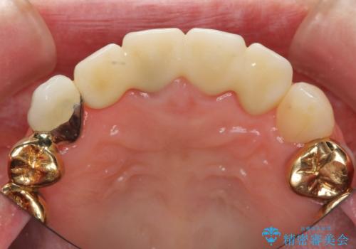 状況に応じた前歯の補綴計画の治療後