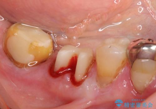 歯ぐきから血が出る、歯ぐきが腫れている 80代女性の治療前