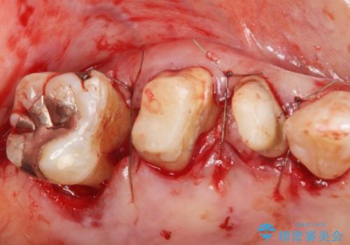 歯ぐきから血が出る、歯ぐきが腫れている 80代女性の治療中