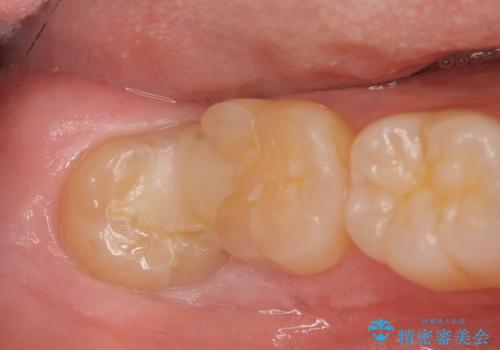 親知らずを起因とする虫歯治療の治療前