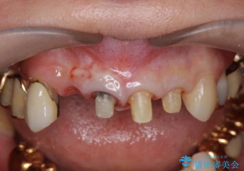 状況に応じた前歯の補綴計画の治療中