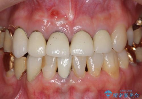 状況に応じた前歯の補綴計画の治療前