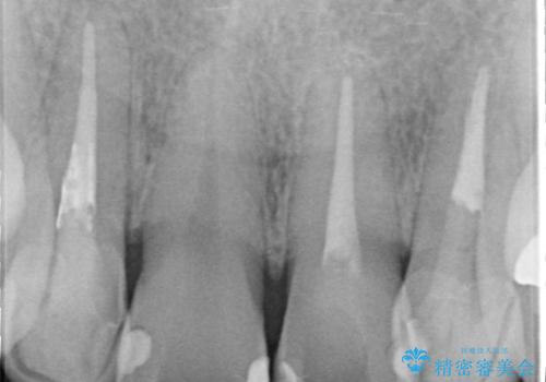 歯並びを含めて前歯をきれいにしたい インビザラインとセラミック治療の治療前