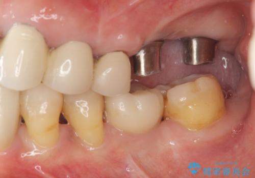 遊離端ブリッジ インプラント補綴への設計変更の治療中
