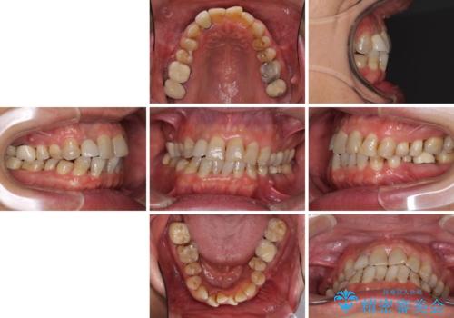 歯列不正と歯周病 総合歯科治療による全顎治療の治療前