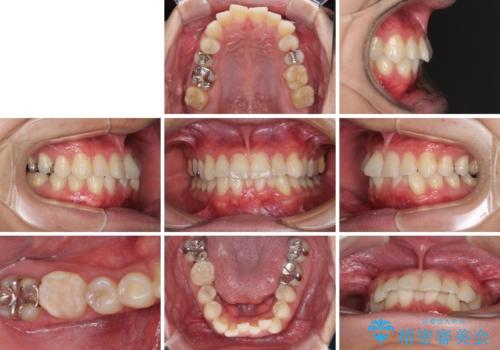 冷たいものがしみて奥歯が痛い 気になる歯並びも治したの治療前