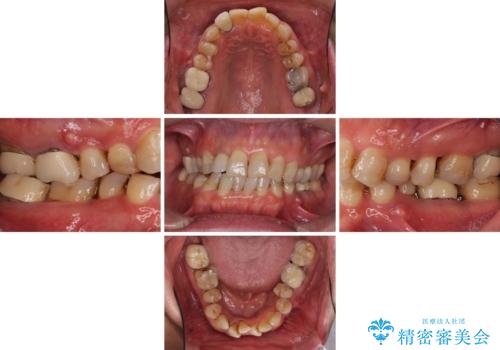 歯列不正と歯周病 総合歯科治療による全顎治療の治療前