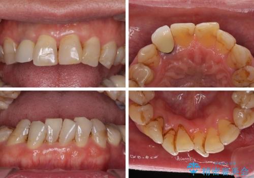 歯列不正と歯周病 総合歯科治療による全顎治療の治療前