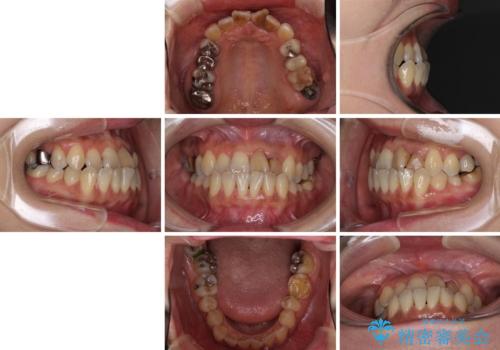 反対咬合で痛む前歯を改善　インビザラインによる矯正治療の治療前