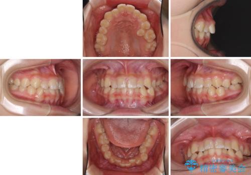 遠方から新幹線で通院 急速拡大装置とインビザラインによる矯正治療の治療前