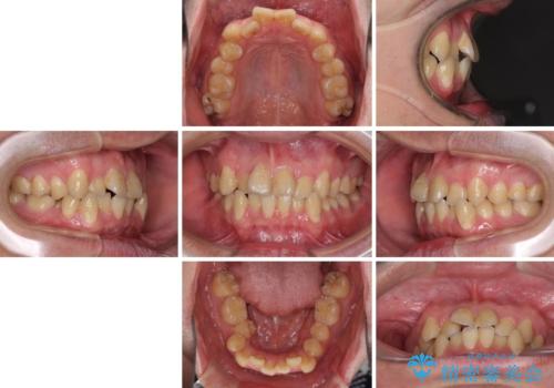 歯列全体のクロスバイトを治したい　ワイヤー装置による矯正治療の治療前
