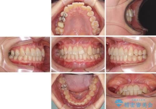 前歯のクロスバイト　インビザライン矯正で改善の治療前