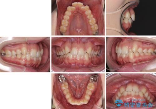骨格的に左右にずれいている 前歯のデコボコをインビザラインで解消の治療前