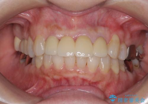 [ 前歯ジルコニアブリッジ ]  前歯の突き上げによる歯牙破折の治療後