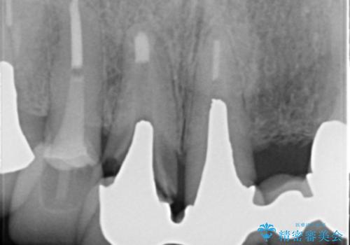 前歯のブリッジの下が虫歯　ブリッジのやりかえの治療前