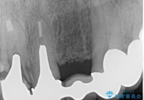 前歯のブリッジの下が虫歯 ブリッジのやりかえの治療前