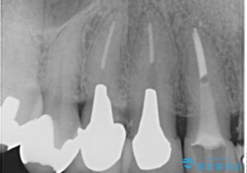 前歯のブリッジの下が虫歯 ブリッジのやりかえの治療前