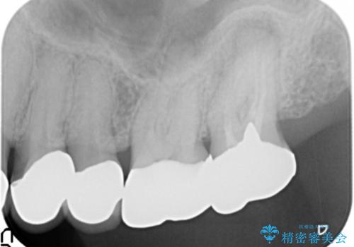 奥歯の被せ物のやり直し 精密根管治療の治療前