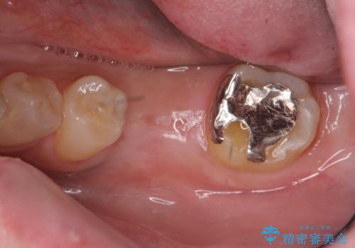 強い噛み合わせによる歯牙破折後のインプラント治療の治療中