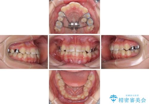 遠方から新幹線で通院 急速拡大装置とインビザラインによる矯正治療の治療前